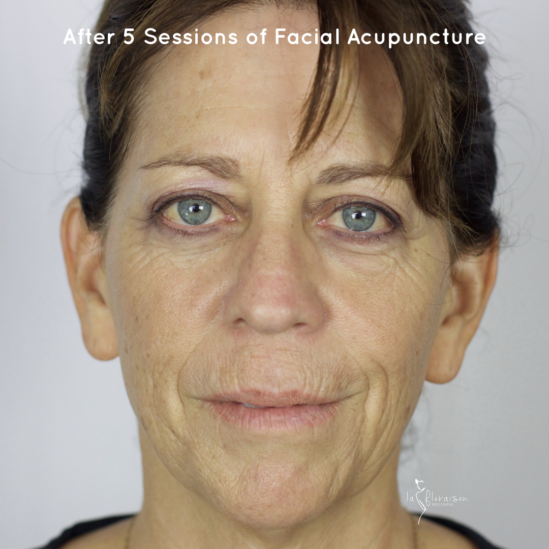 How long does it take to see results after Facial Rejuvenation Acupuncture