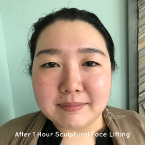 Post Sculptural Face Lifting 1 session